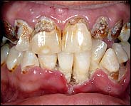 meth mouth